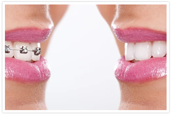 Caplash Dental Braces