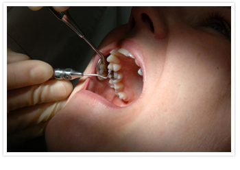 Caplash Dental tooth filling