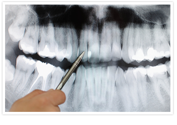Caplash Dental Root canal