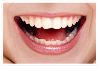 Caplash Dental white filling