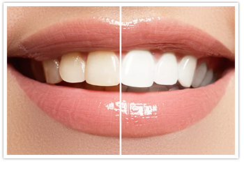 Caplash Dental Teeth Whitening