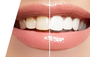 Teeth Whitening Brampton