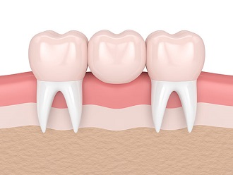 Caplash Dental Crowns & Bridges