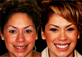 Dental veneers Brampton