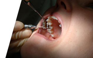 Dental filling Brampton