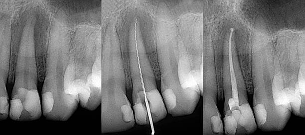 Root canal treatment Brampton