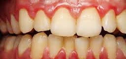 GINGIVITIS tratment brampton