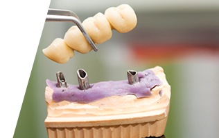 Mini Implants Brampton