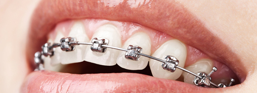 Orthodontist in Brampton