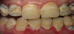 PERIODONTITIS tratment brampton